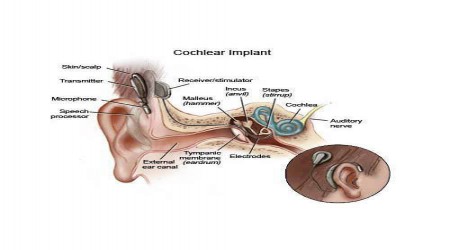 Bionic Cochlear Implant by Shravani Speech & Hearing Centre