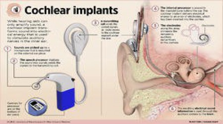 Cochlear Implant by Bengal Speech & Hearing Private Limited