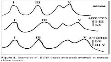 Bera Or Brain Stem Evoked Response Audiometry by Hi Tone Hearing
