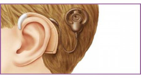 Cochlear Implants by BEST Foundation