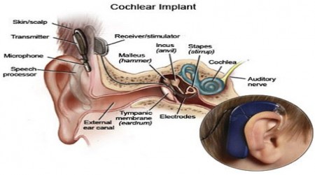 Cochlear Implant by Sree Gayatri Hearing Care Clinic
